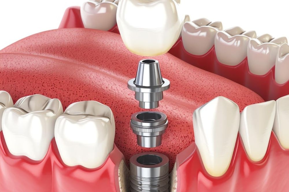 Dental Implants With an Autoimmune Disease