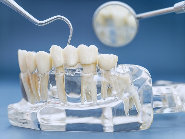 how do you know if a dental bridge is right for you