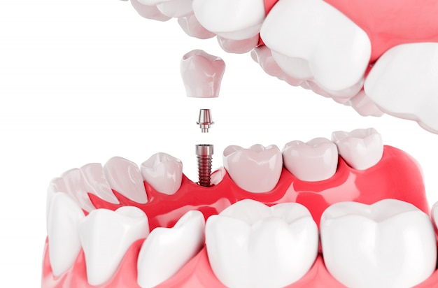 what should you expect during the dental implant process